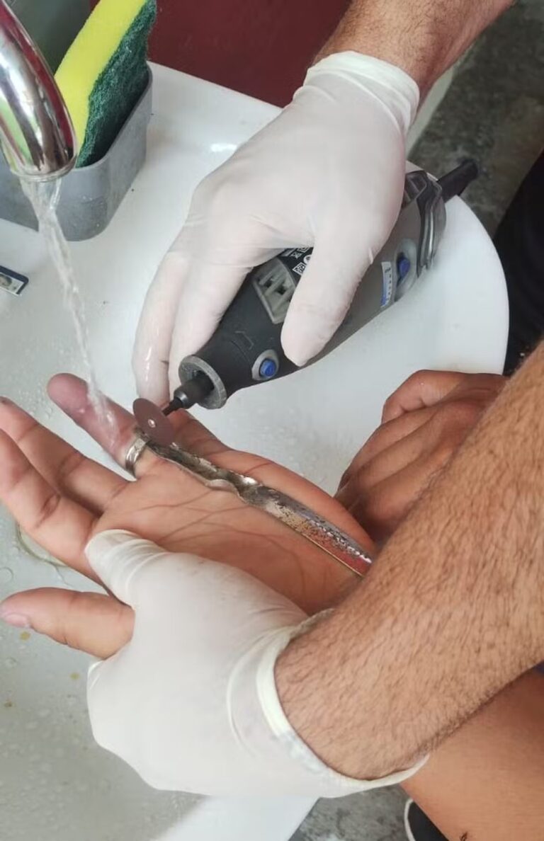 Cresce o número de pessoas socorridas com anéis presos aos dedos em Manaus; alta foi de 20% em 2025